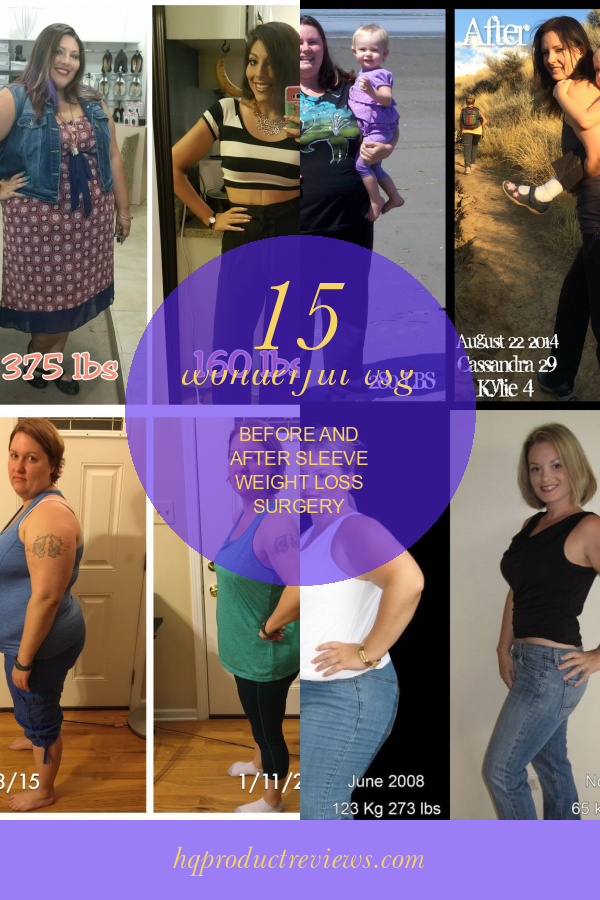 15 Wonderful Vsg Before And After Sleeve Weight Loss Surgery Best Product Reviews 9247